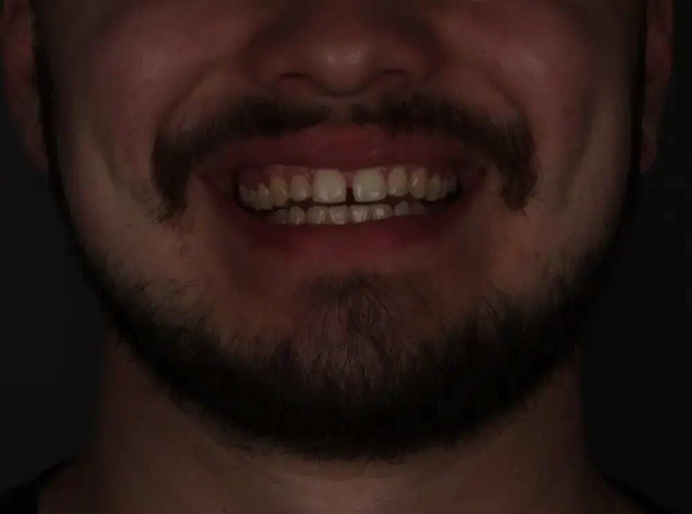 Fechamento de diastema: antes do tratamento
