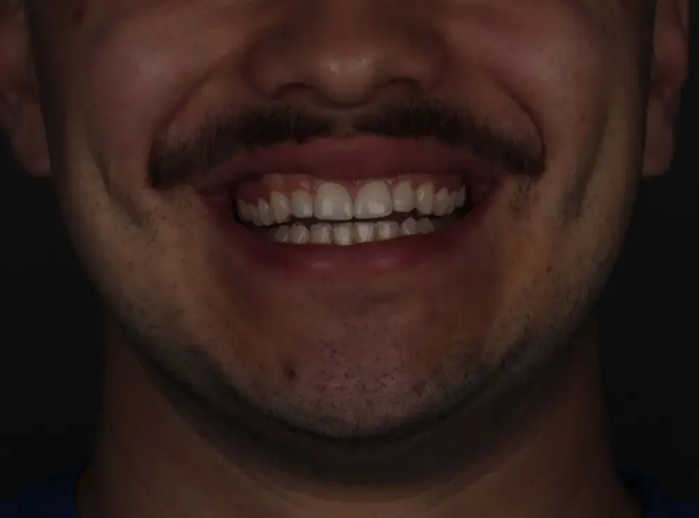 Fechamento de diastema: depois do tratamento