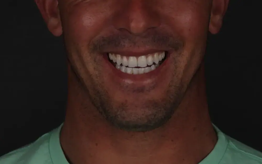 Restauração estética: antes do tratamento