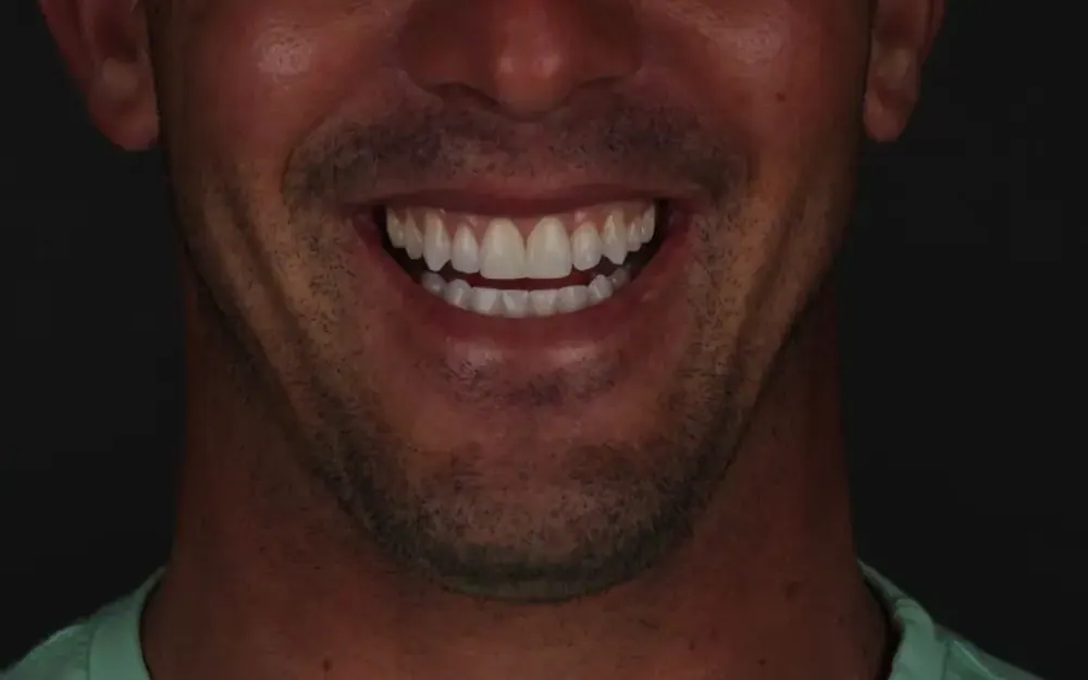 Restauração estética: depois do tratamento