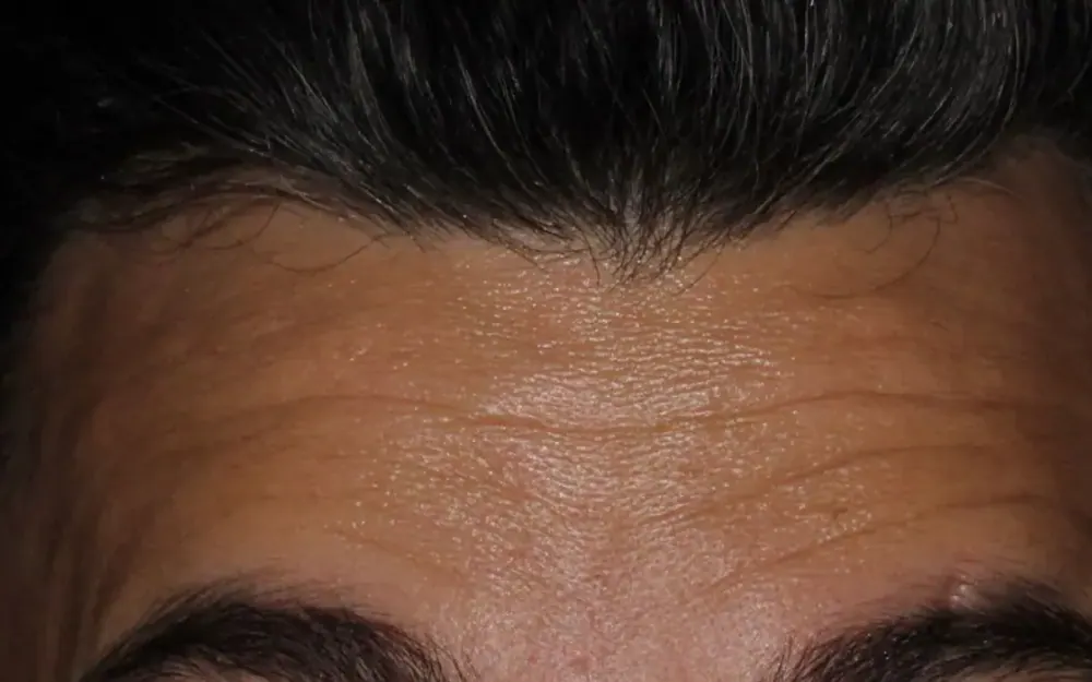 Toxina botulínica: antes do tratamento