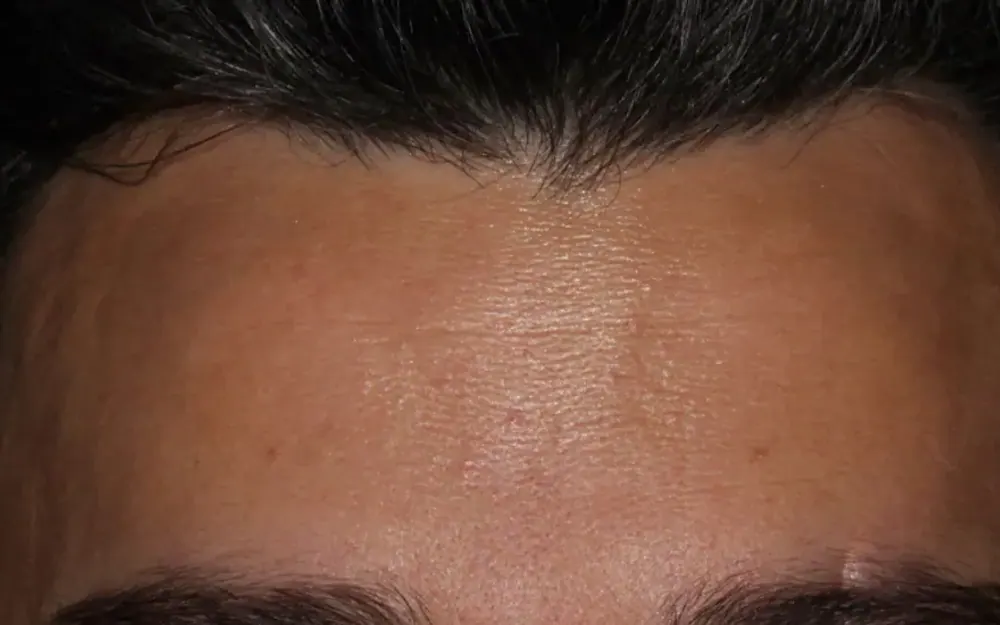 Toxina botulínica: depois do tratamento