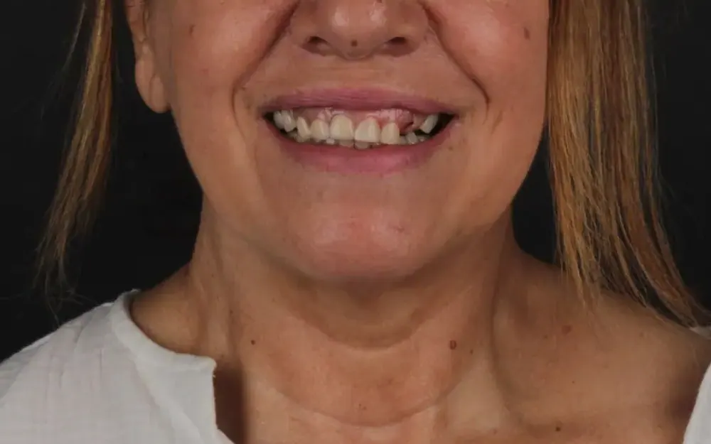 Reabilitação do sorriso: antes do tratamento