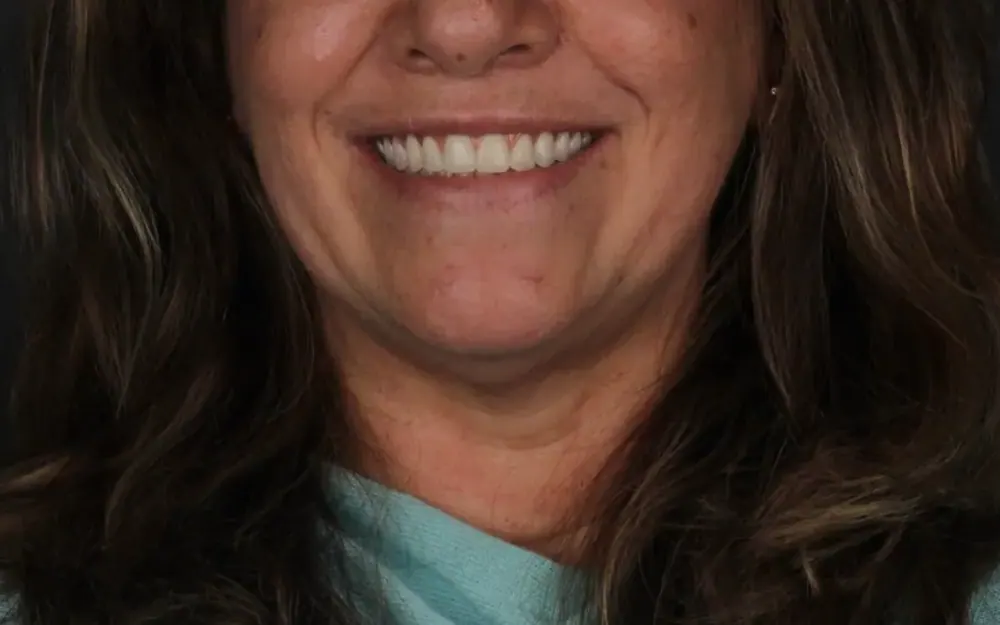 Reabilitação do sorriso: depois do tratamento