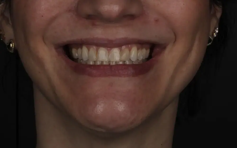 Facetas de resina: antes do tratamento