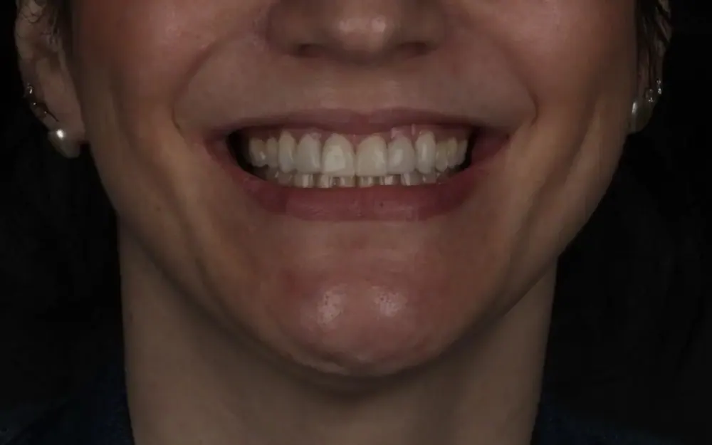 Facetas de resina: depois do tratamento