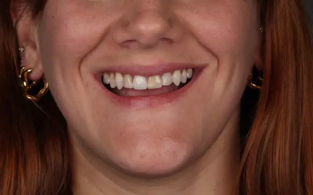 Facetas de resina: antes do tratamento