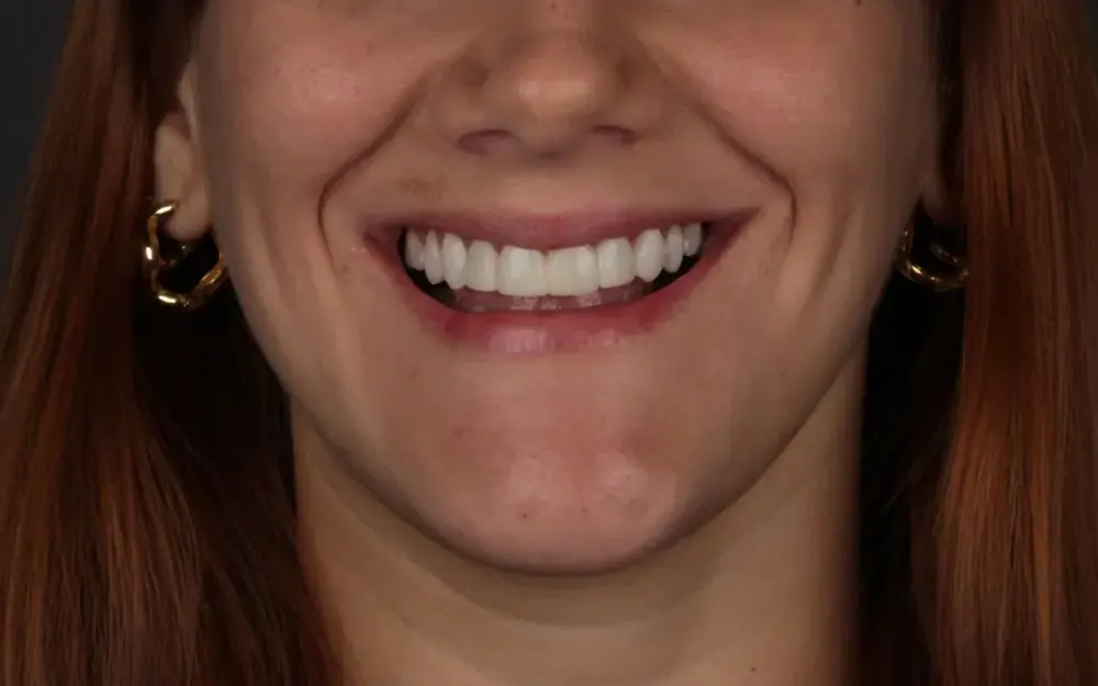 Facetas de resina: depois do tratamento