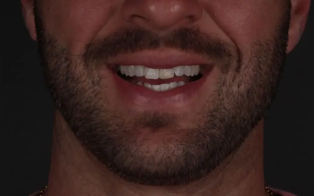 Restauração estética: antes do tratamento