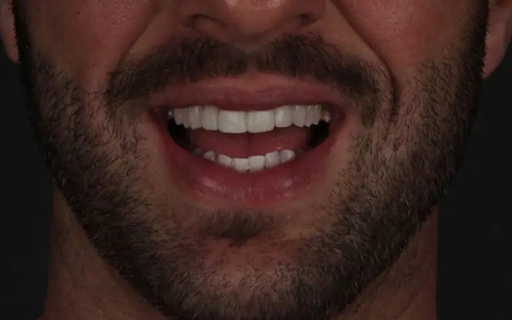 Restauração estética: depois do tratamento