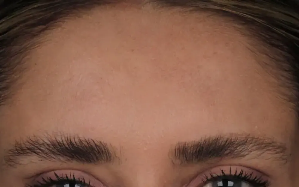 Glabela: depois do tratamento