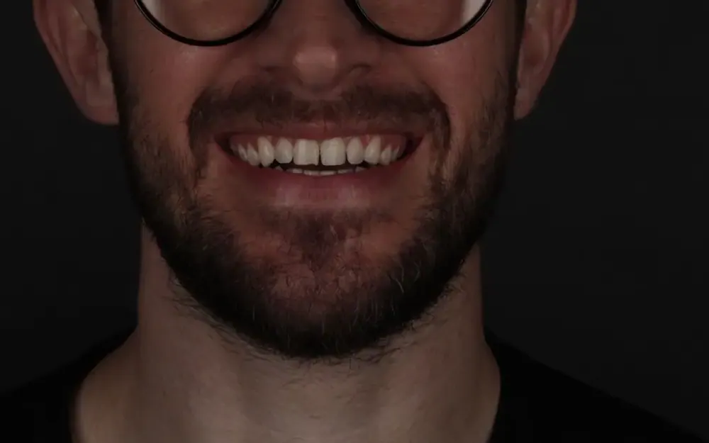 Facetas de resina: antes do tratamento