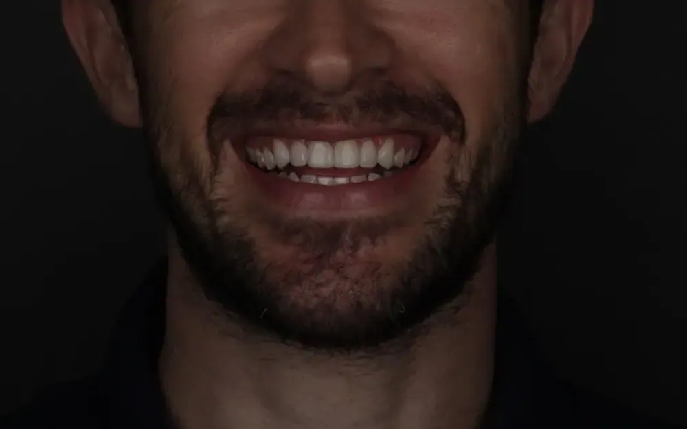 Facetas de resina: depois do tratamento