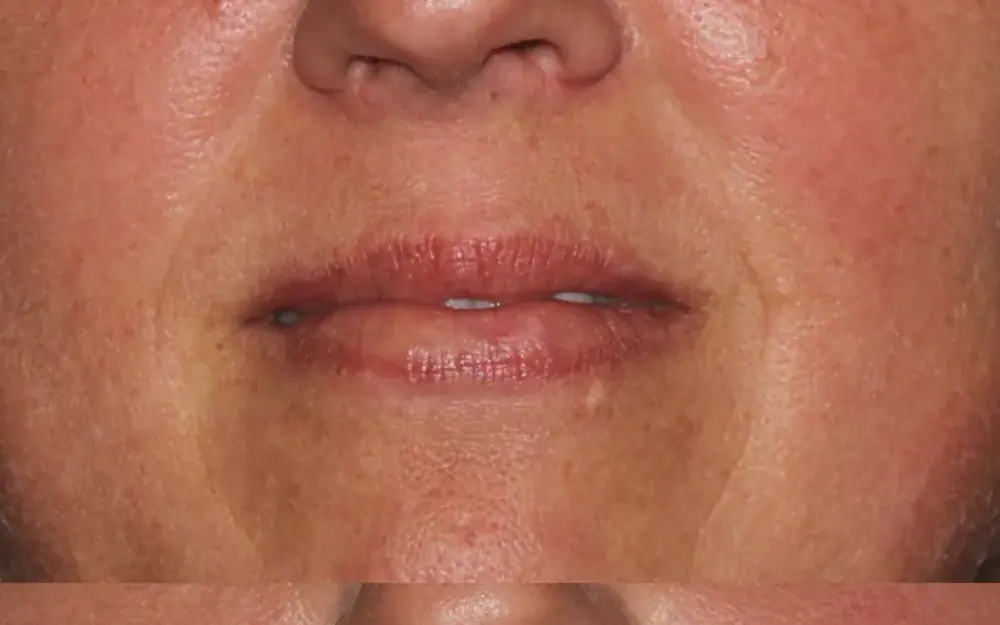 Preenchimento labial: antes do tratamento
