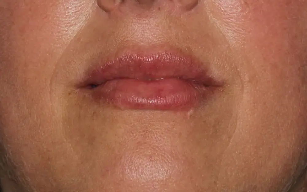 Preenchimento labial em Tubarão/SC - Clínica Dra. Lúcia Ribeiro