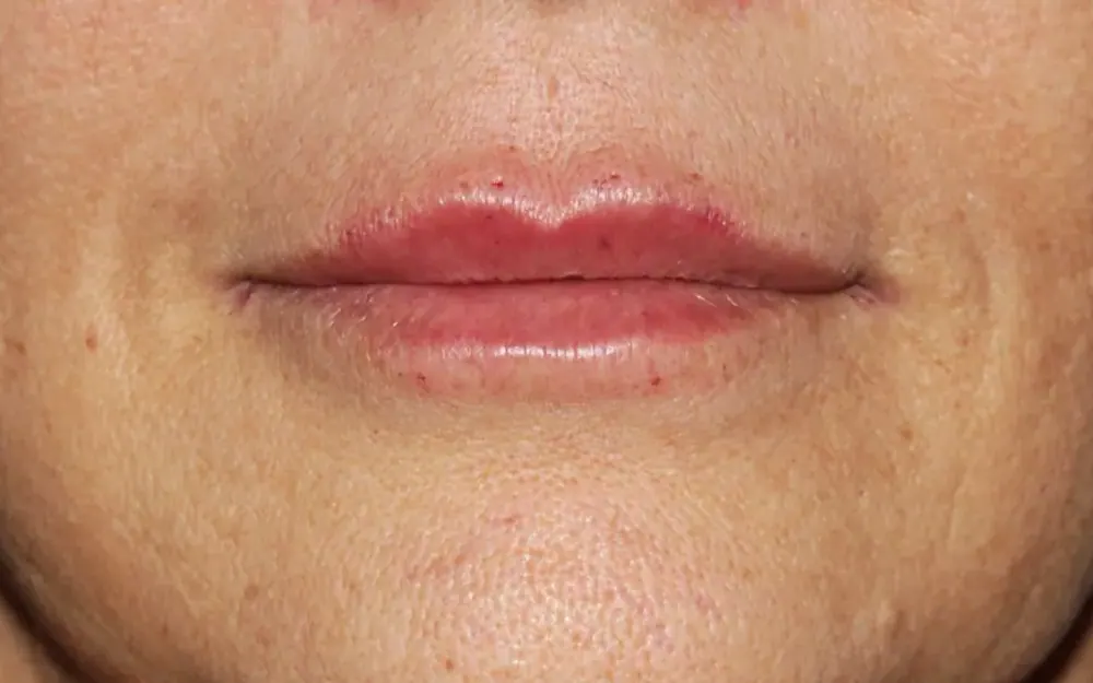 Lábio e bigode chinês: depois do tratamento