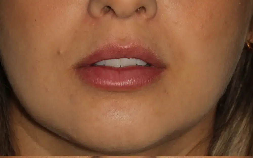 Preenchimento labial: antes do tratamento