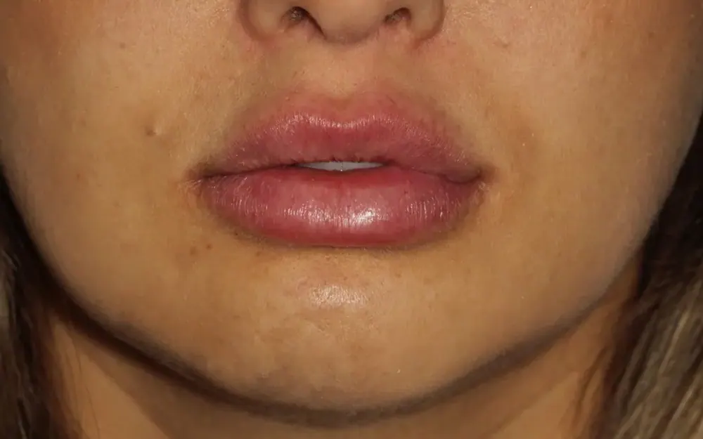 Preenchimento labial: depois do tratamento