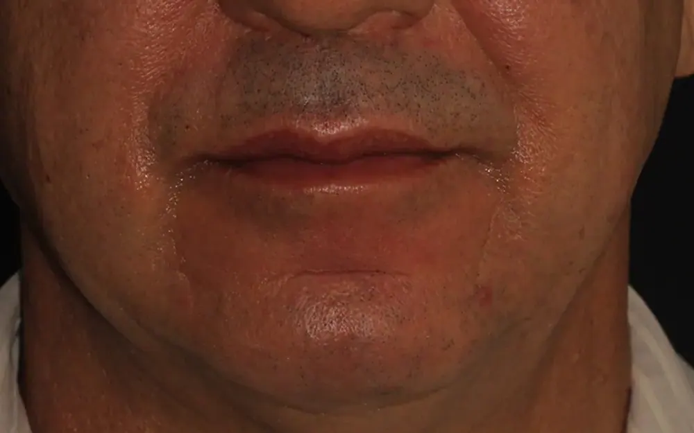 Preenchimento labial: antes do tratamento