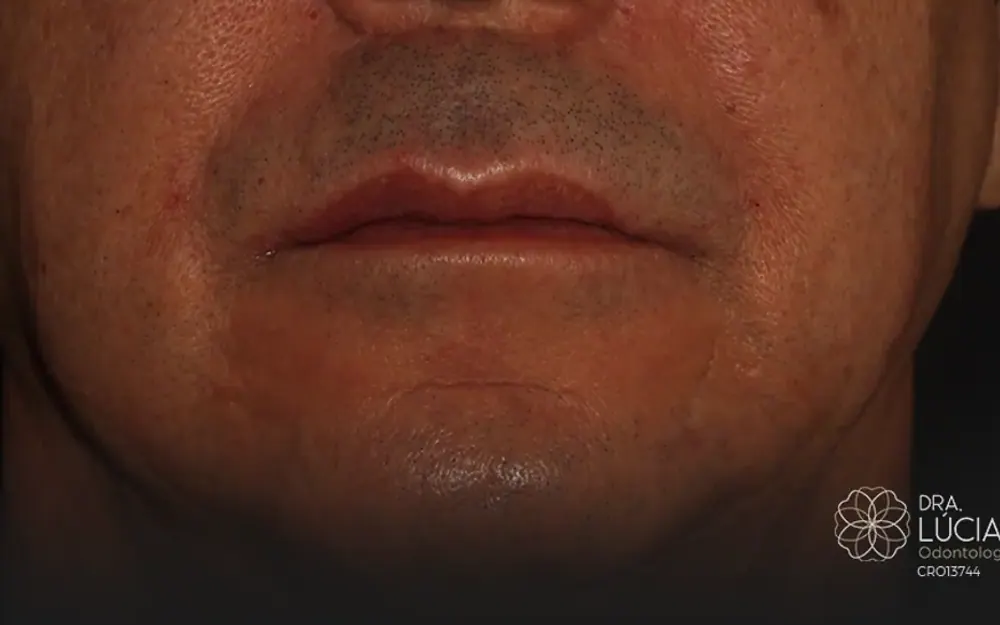 Preenchimento labial: depois do tratamento