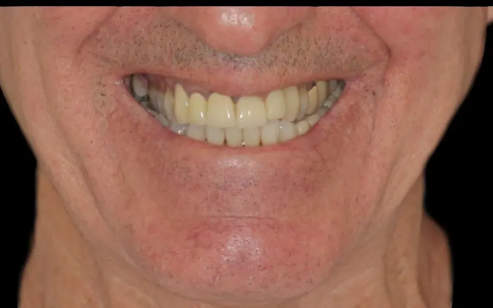 Lentes de contato dental: antes do tratamento