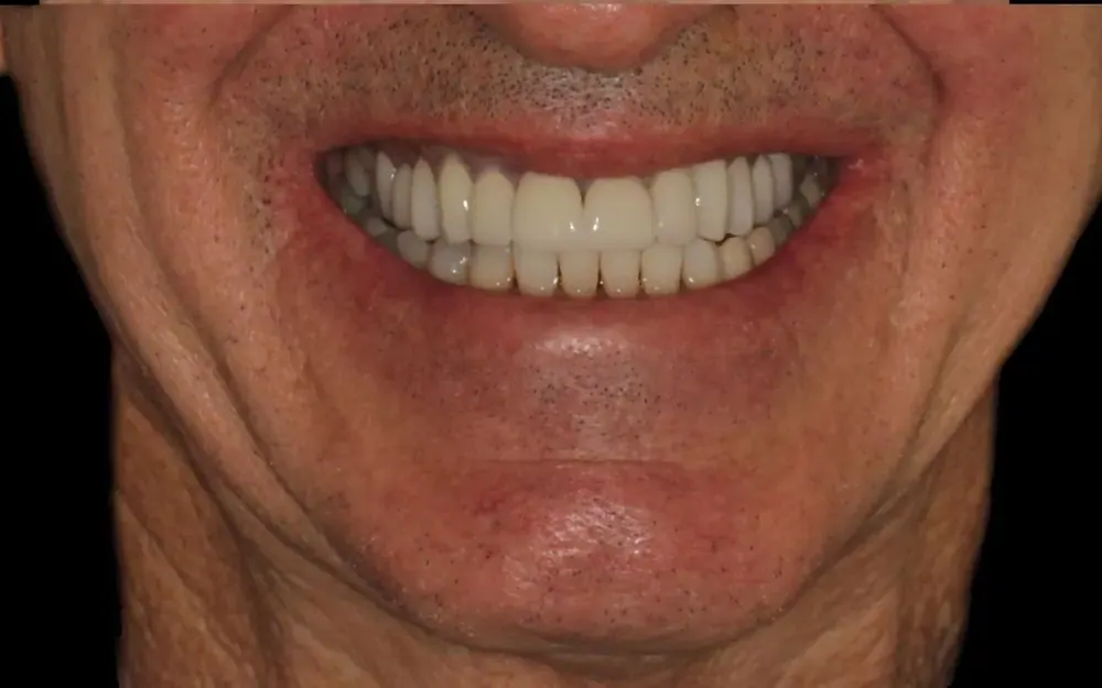 Lentes de contato dental: depois do tratamento