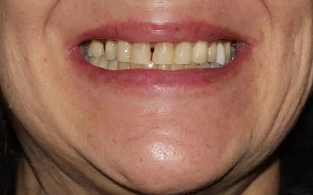 Lentes de contato e coroa: antes do tratamento