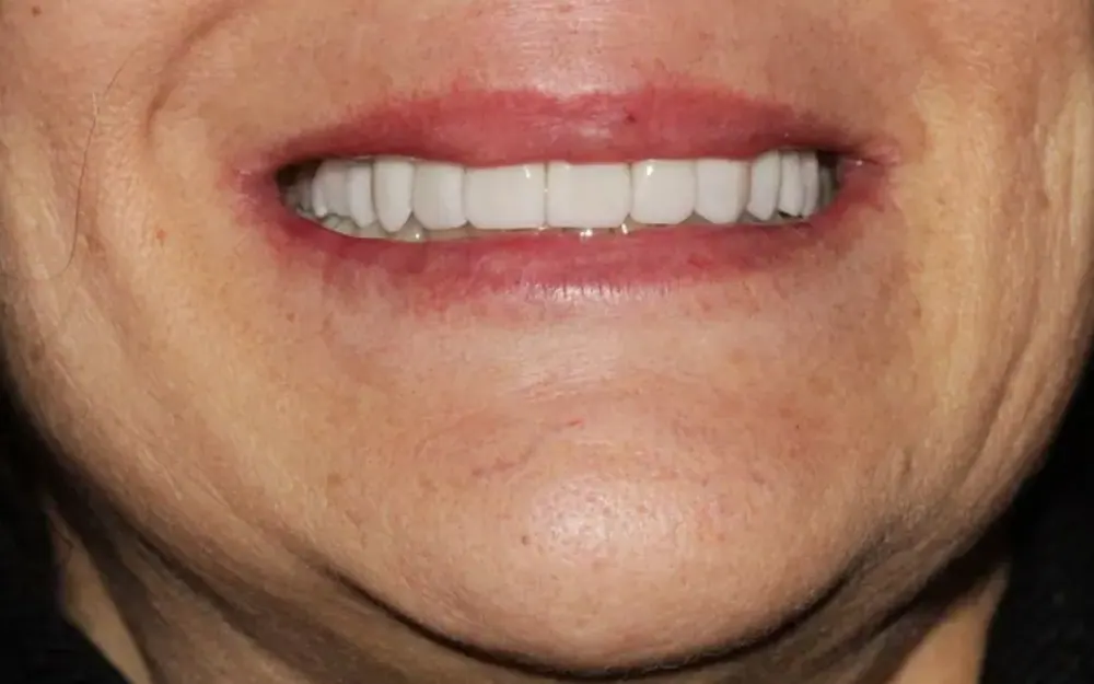 Lentes de contato e coroa: depois do tratamento