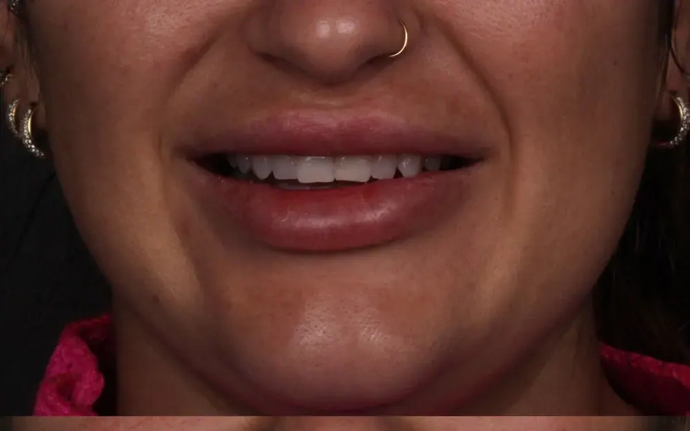 Facetas: antes do tratamento