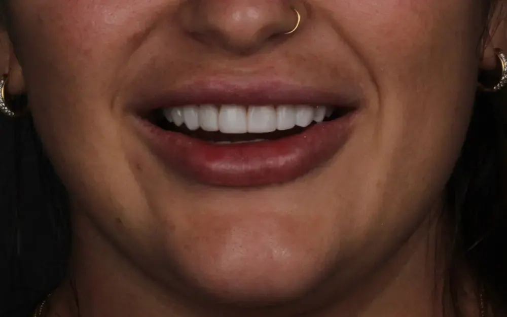 Facetas: depois do tratamento