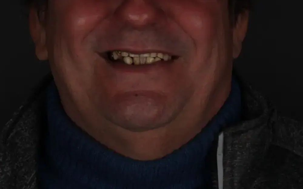 Reabilitação do sorriso: antes do tratamento