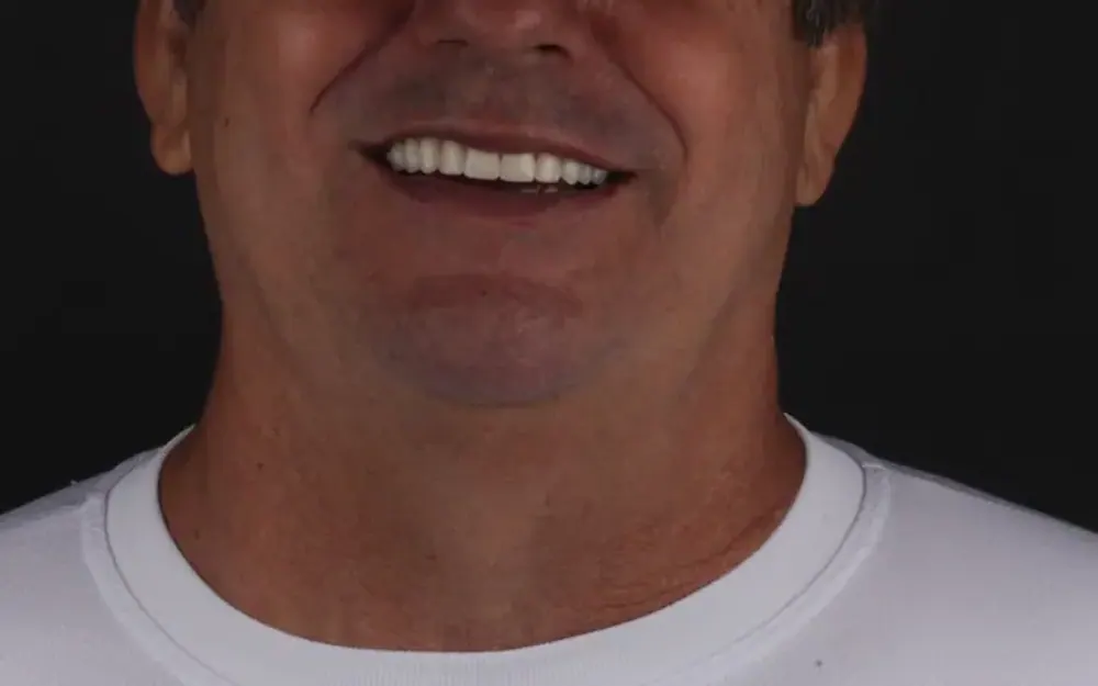 Reabilitação do sorriso: depois do tratamento