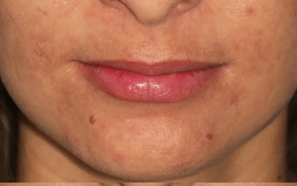 Preenchimento labial: antes do tratamento