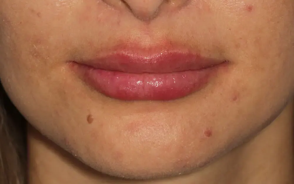 Preenchimento labial: depois do tratamento