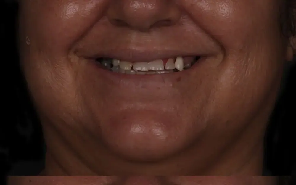 Reabilitação do sorriso: antes do tratamento