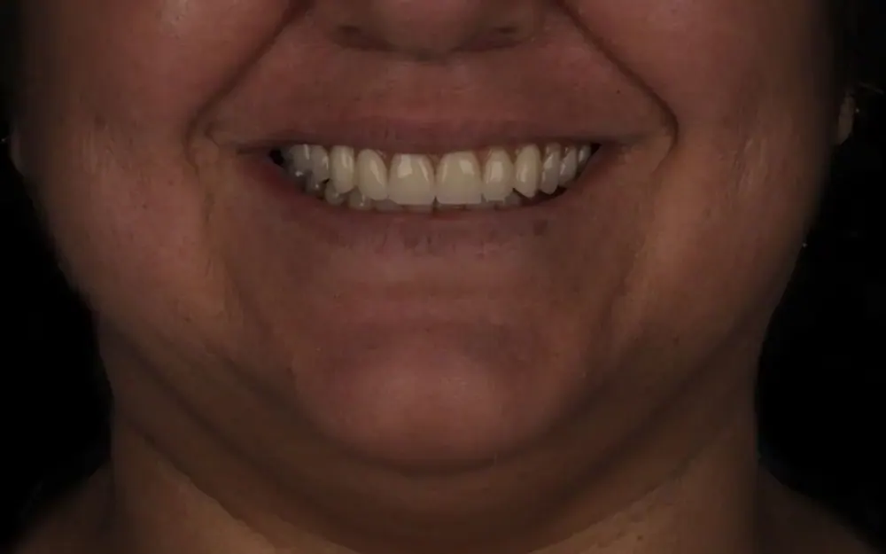 Reabilitação do sorriso: depois do tratamento