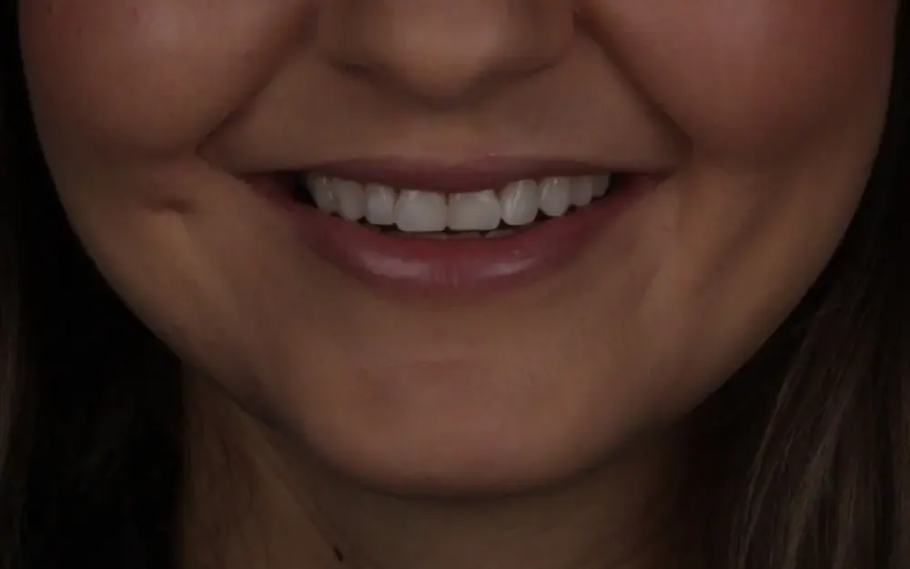 Facetas: antes do tratamento