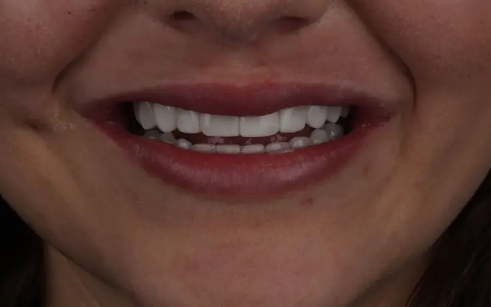 Facetas: depois do tratamento
