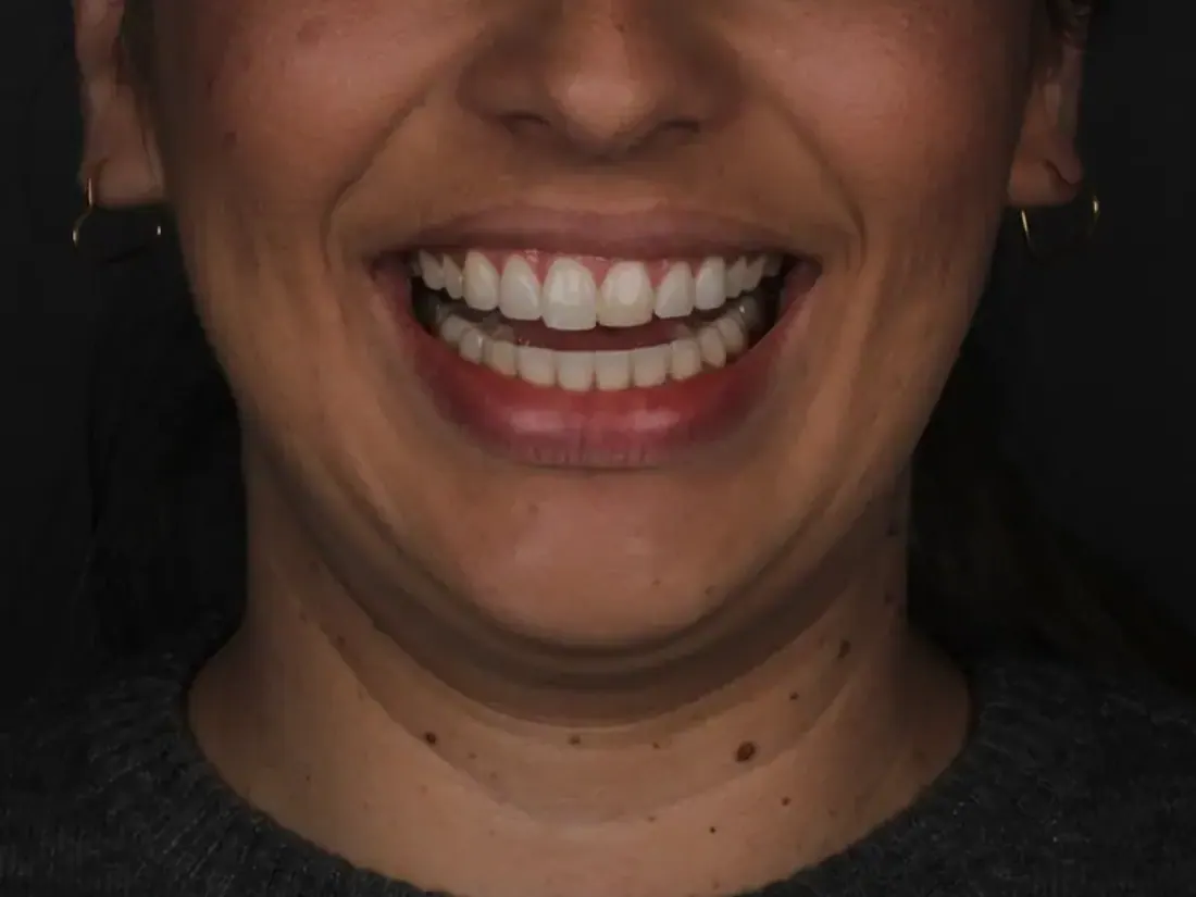 Clareamento dental em Tubarão/SC - Clínica Dra. Lúcia Ribeiro