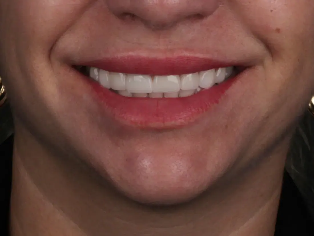 Lentes de contato dental em Tubarão/SC - Clínica Dra. Lúcia Ribeiro