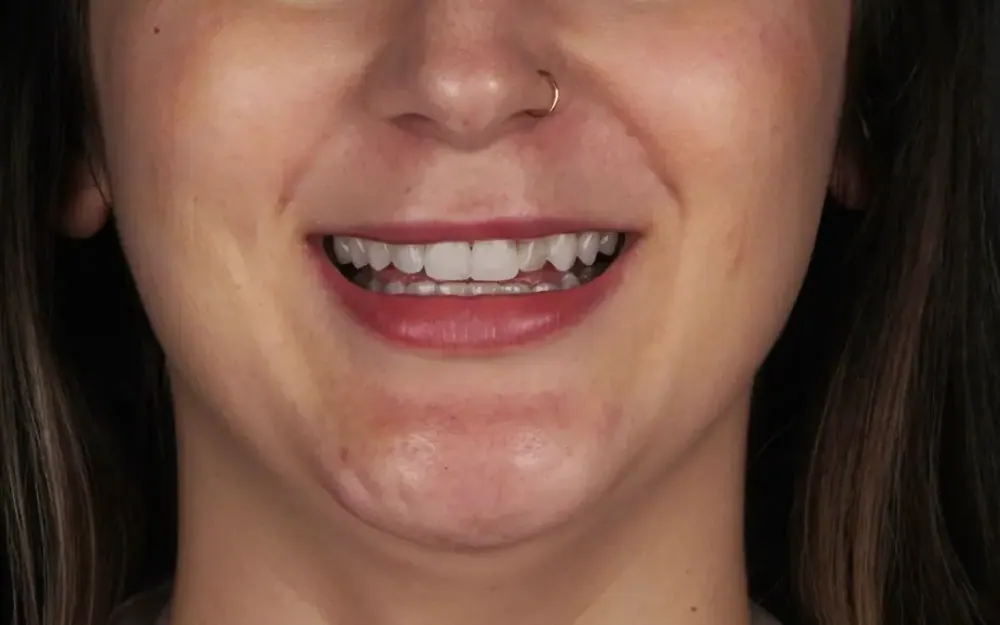 Facetas de resina: antes do tratamento