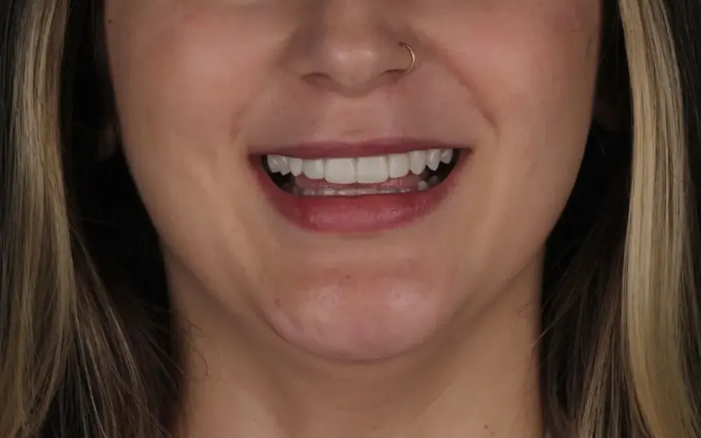 Facetas de resina: depois do tratamento