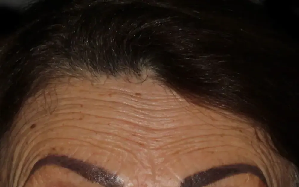 Toxina botulínica: antes do tratamento