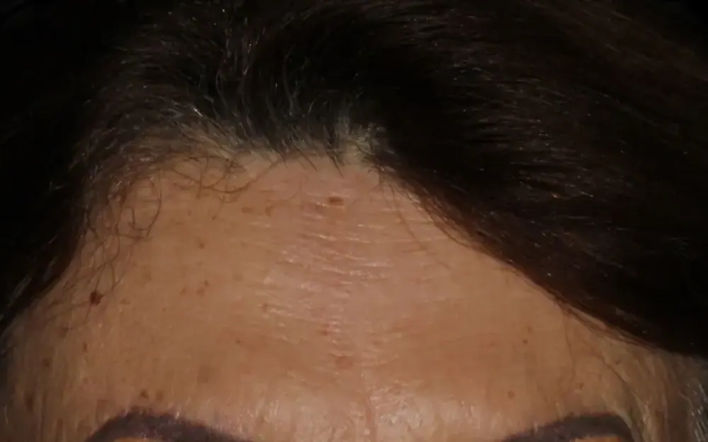 Toxina botulínica: depois do tratamento